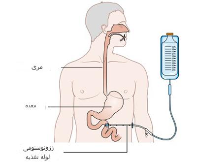 لوله ژژنوستومی عکس ژژنوستومی | آموزش به بیمار | بیمارستان قائم مشهد